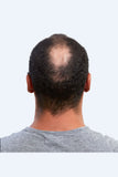 Man with balding showing his hair from the back before wearing  Marc men's hair replacement system