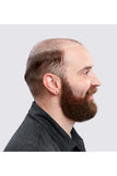 Male with progressive hair loss