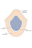 Diagram of the  Marcel Men's Semi Permanent Hair Replacement System from Fascinations 