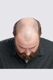 Man with hair loss 