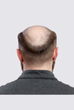 Man with balding showing the back of his head 